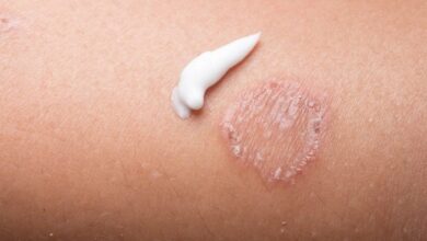 5 rekomendasi obat jamur kulit yang ada di apotek