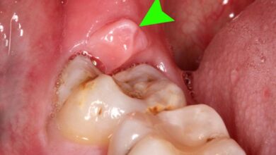 5 gejala perikoronitis yang wajib diwaspadai