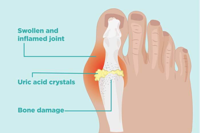 5 fakta mengenai asam urat