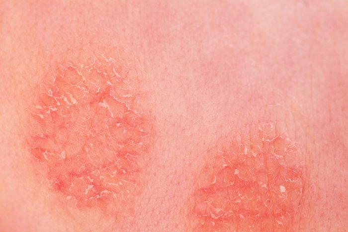 2 tes untuk deteksi dermatitis numularis