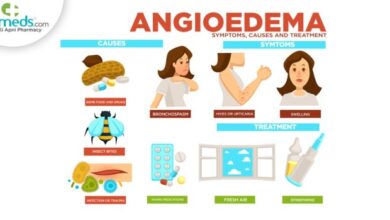 2 pencegahan angioedema yang bisa dilakukan