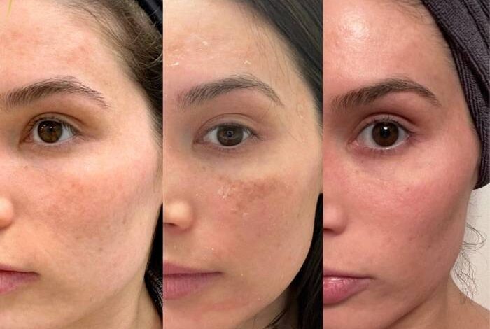 5 hal yang perlu diketahui sebelum peeling wajah