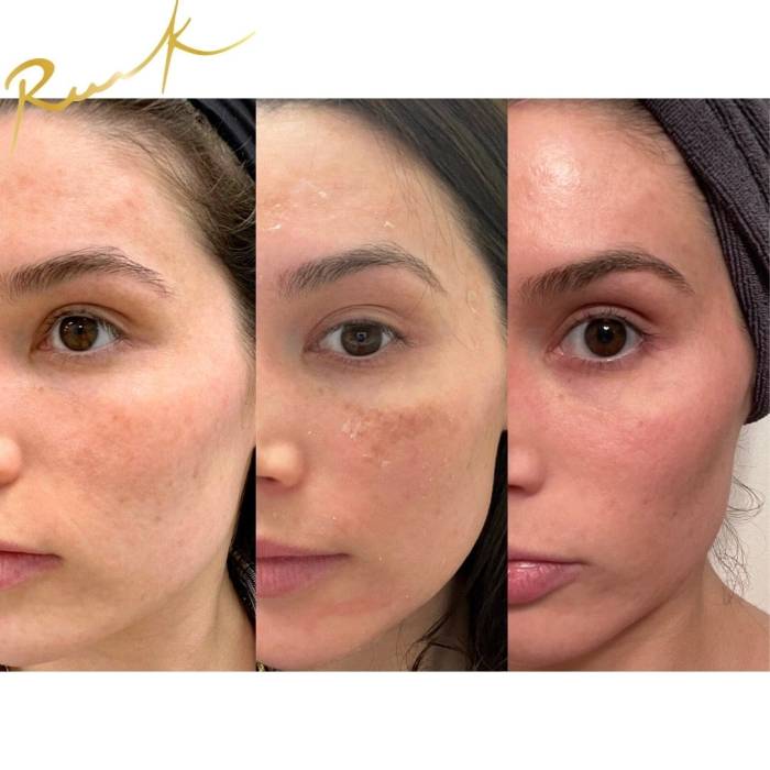 5 hal yang perlu diketahui sebelum peeling wajah