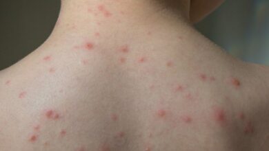 5 mitos tentang cacar air yang tidak perlu dipercaya