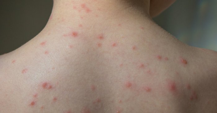 Vaccine pox chicken chickenpox school 5 mitos tentang cacar air yang tidak perlu dipercaya