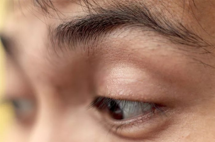 5 faktor risiko sebabkan floppy eyelid syndrome