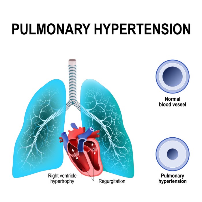 5 faktor risiko seseorang bisa terkena hipertensi pulmonal