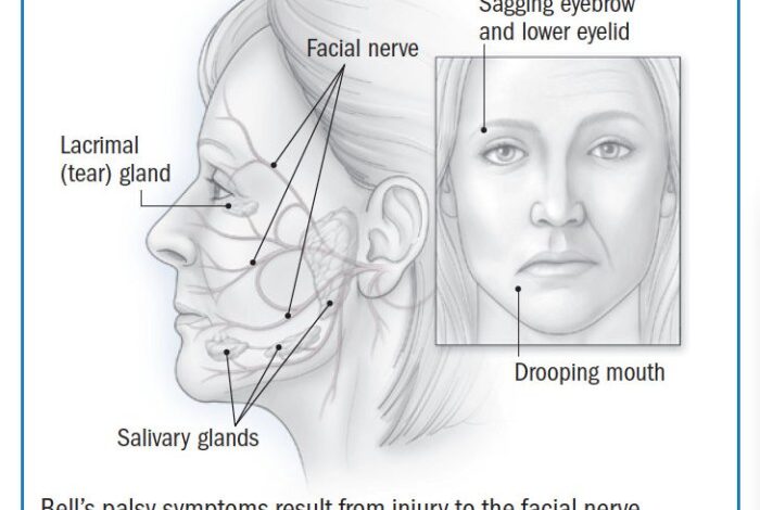 2 tes yang digunakan untuk mendeteksi bell s palsy