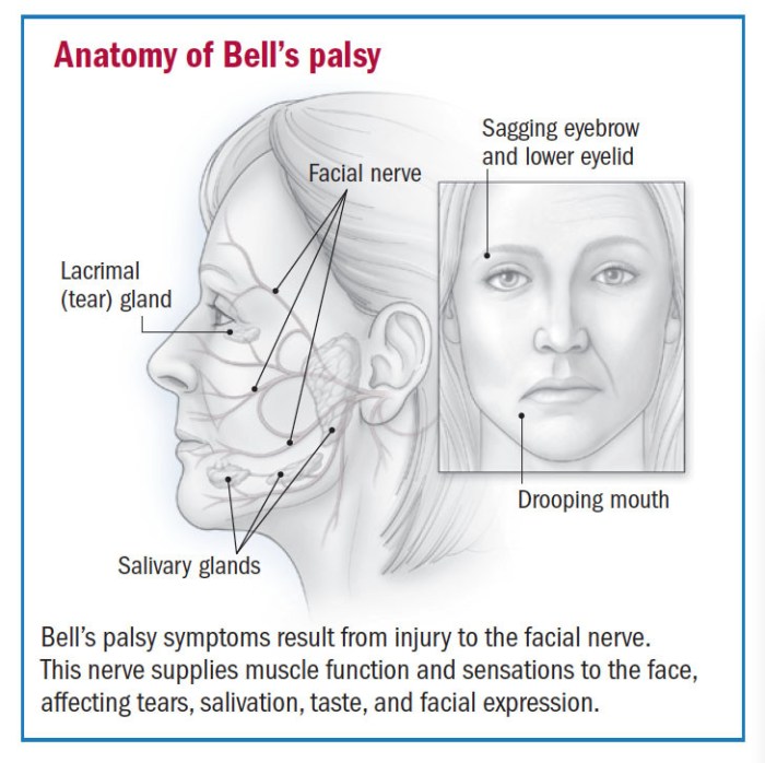 2 tes yang digunakan untuk mendeteksi bell s palsy