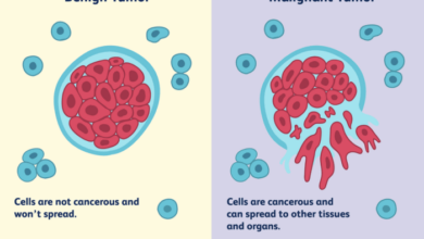 5 jenis tumor tulang jinak yang perlu diketahui