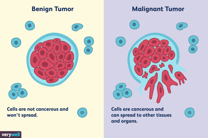 5 jenis tumor tulang jinak yang perlu diketahui