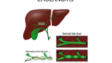 5 fakta tentang penyakit cholangitis yang perlu diketahui