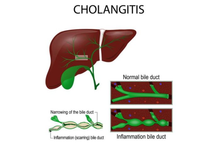 5 fakta tentang penyakit cholangitis yang perlu diketahui