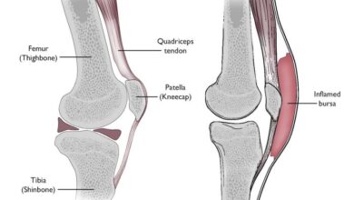 3 bagian tubuh tempat terjadi bursitis