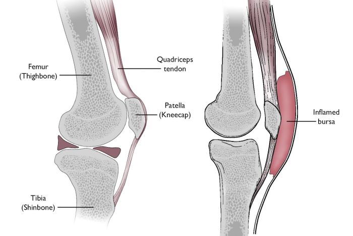 3 bagian tubuh tempat terjadi bursitis