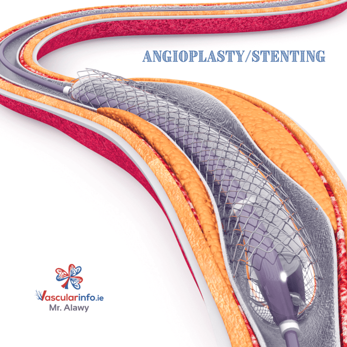 5 prosedur untuk mendiagnosis arteriosklerosis