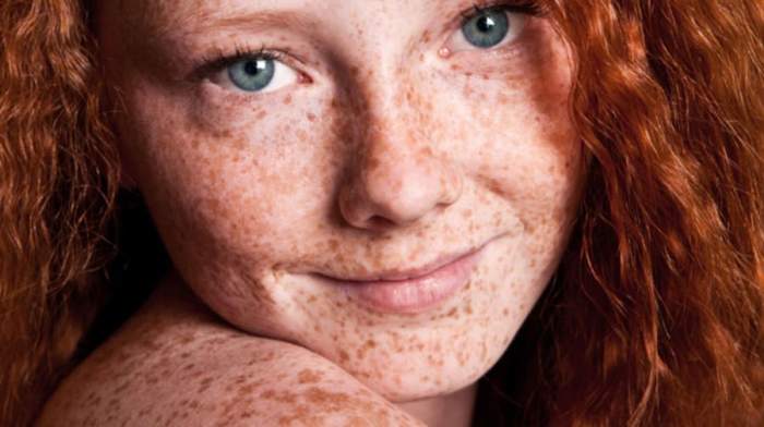 5 fakta tentang freckle yang menarik untuk diketahui