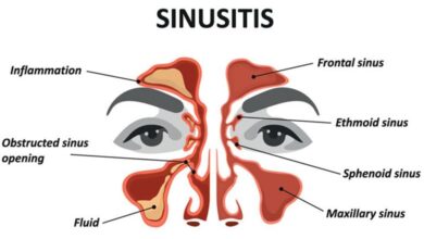 5 fakta mengenai sinusitis