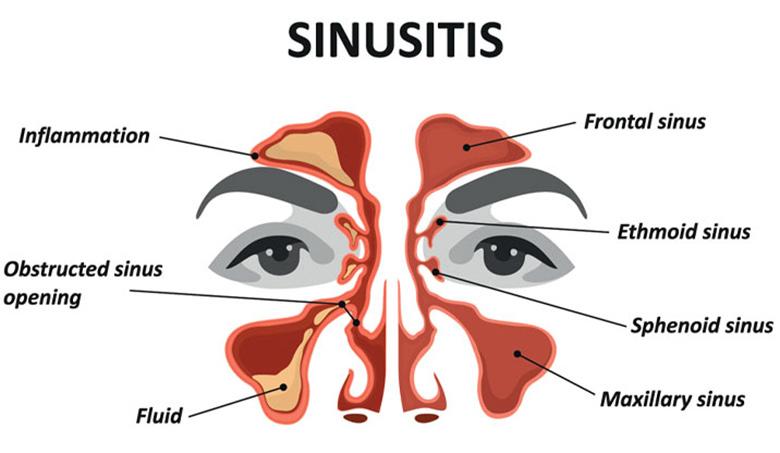 5 fakta mengenai sinusitis