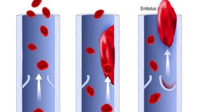 5 penyebab munculnya emboli alias pasokan darah ke tubuh