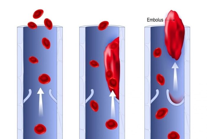 5 penyebab munculnya emboli alias pasokan darah ke tubuh