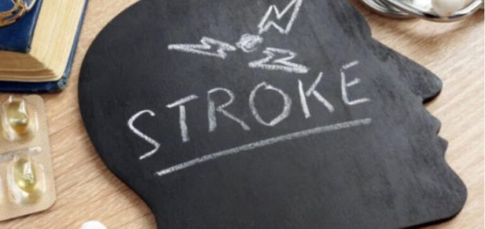 5 fakta tentang stroke yang harus diketahui