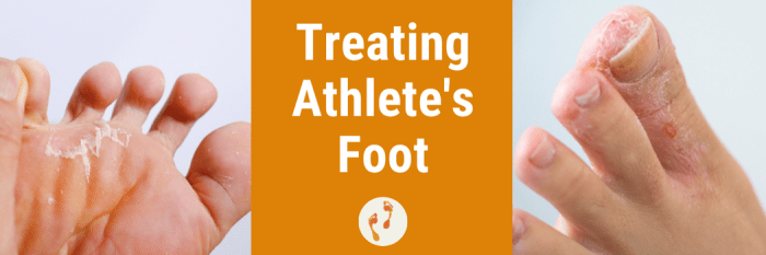 5 perawatan sederhana untuk mencegah kutu air