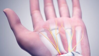 5 cara mengobati carpal tunnel syndrome tanpa operasi