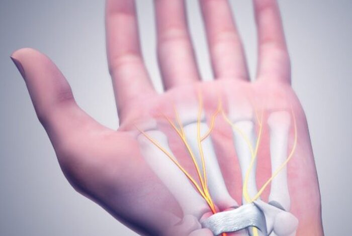 5 cara mengobati carpal tunnel syndrome tanpa operasi