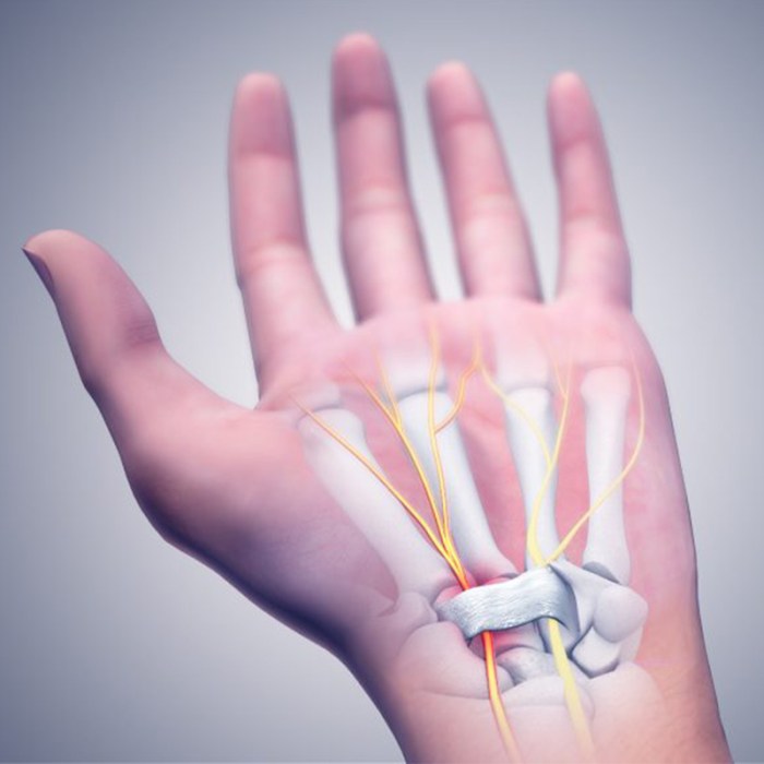 5 cara mengobati carpal tunnel syndrome tanpa operasi