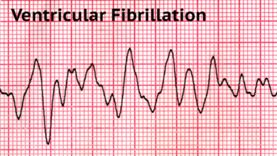 5 pengobatan fibrilasi ventrikel