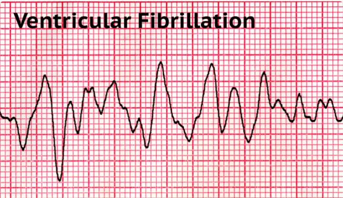 5 pengobatan fibrilasi ventrikel