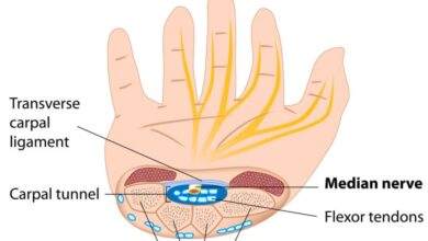 5 mitos dan fakta terkait carpal tunnel syndrome