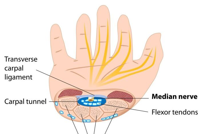 5 mitos dan fakta terkait carpal tunnel syndrome