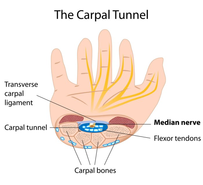 5 mitos dan fakta terkait carpal tunnel syndrome
