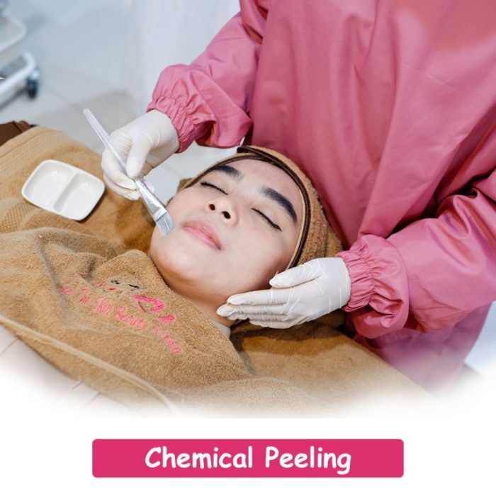 5 manfaat prosedur chemical peeling untuk kulit berjerawat