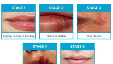 5 fakta tentang sariawan