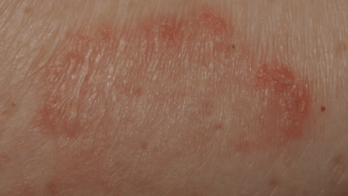 5 penyebab gejala ruam payudara dan cara mengatasinya