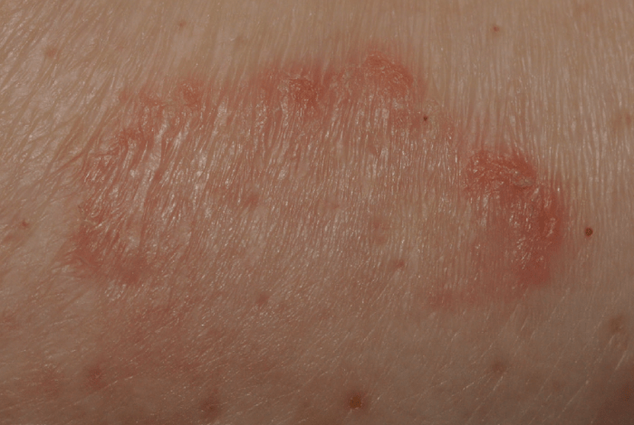 5 penyebab gejala ruam payudara dan cara mengatasinya