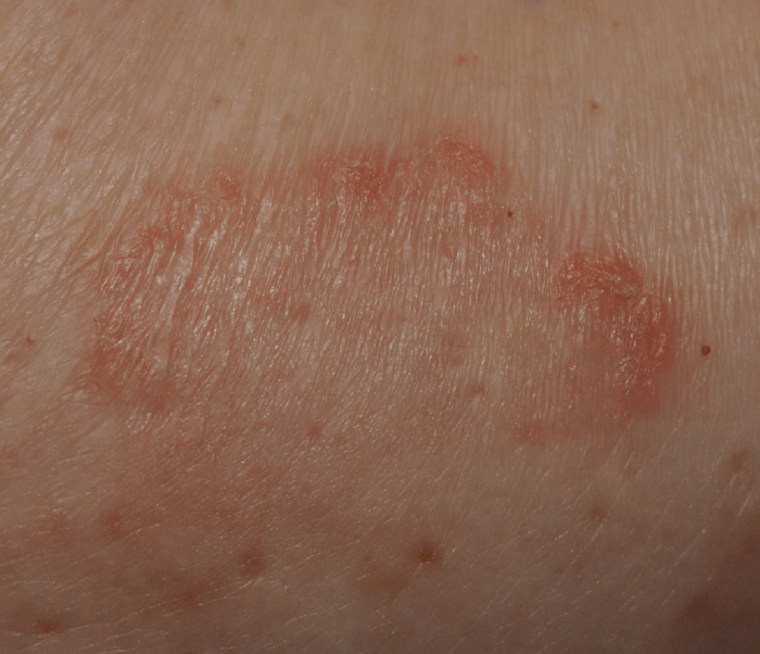 5 penyebab gejala ruam payudara dan cara mengatasinya