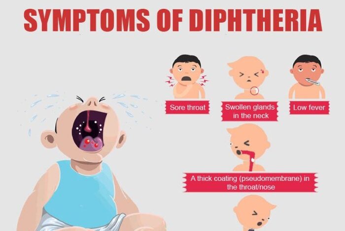 5 gejala difteri yang harus segera ditangani