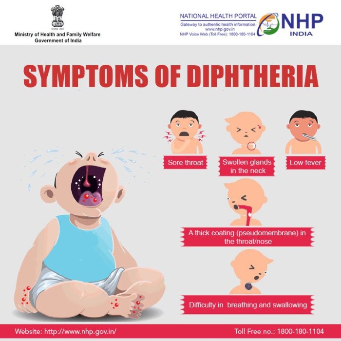 5 gejala difteri yang harus segera ditangani