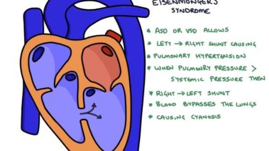 5 kebiasaan yang memperburuk gejala sindrom eisenmenger