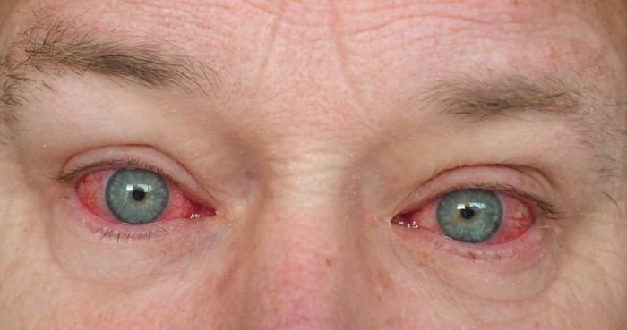 Eye drops redness 5 pilihan obat sakit mata merah tanpa resep dokter