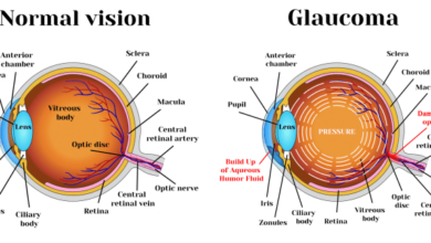 5 jenis penyakit glaukoma yang perlu diketahui