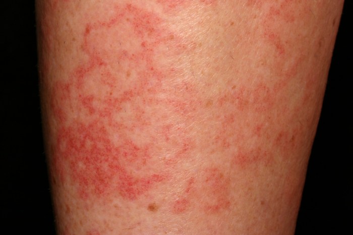 5 pemicu penyakit vaskulitis yang perlu kamu perhatikan