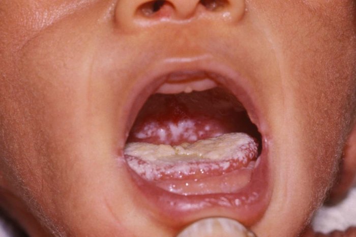 5 faktor yang meningkatkan risiko terkena oral thrush