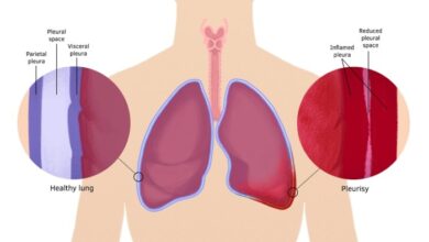 5 fakta tentang penyakit pleuritis