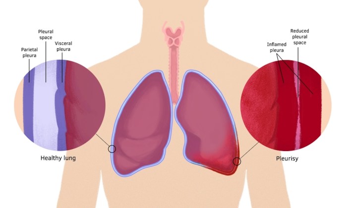 5 fakta tentang penyakit pleuritis