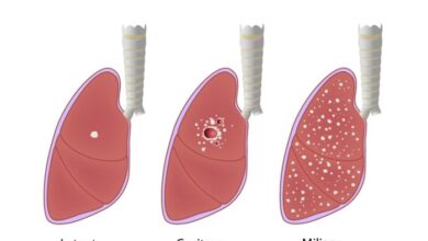 5 olahraga yang tepat untuk tuberkulosis